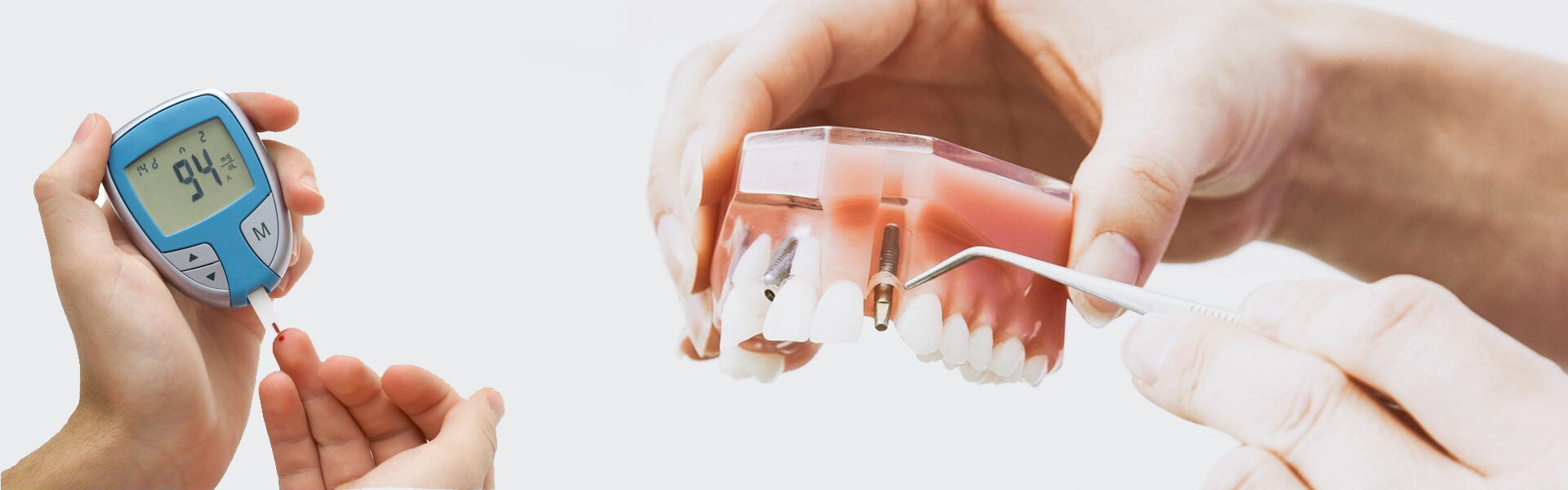 Diabetes and Dental implant