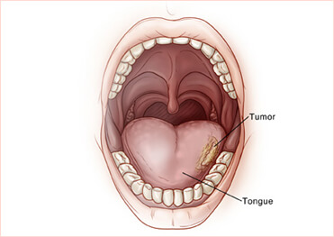Oral Cancer Surgeries